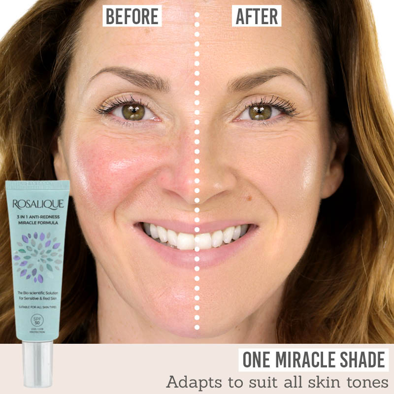 Rosalique 3 in 1 Anti Redness Miracle Formula before and after results