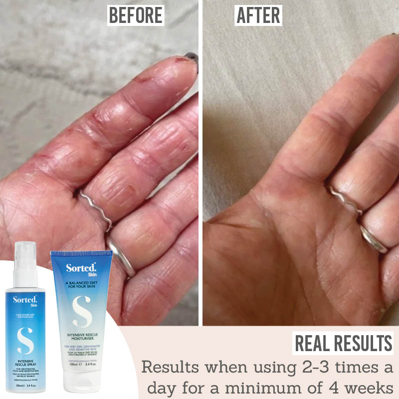 Sorted Skin Intensive Rescue Spray and Moisturiser Duo before and after results
