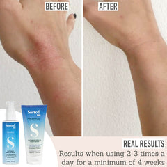 Sorted Skin Intensive Rescue Spray and Moisturiser Duo before and after results